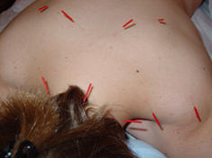 Wasilla Palmer Mat-Su acupuncture & massage clinic